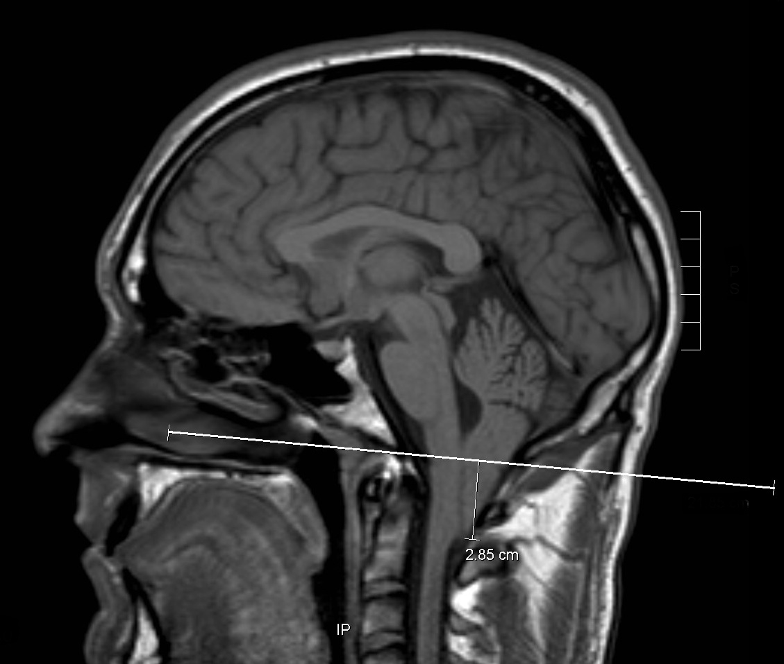 chiari malformation type 1